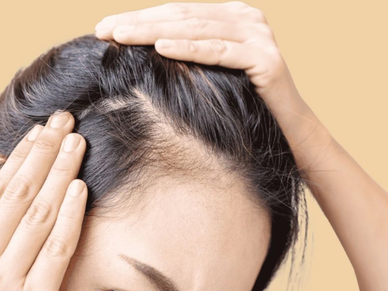 Các cách trị rụng tóc tự nhiên, hiệu quả ngay tại nhà