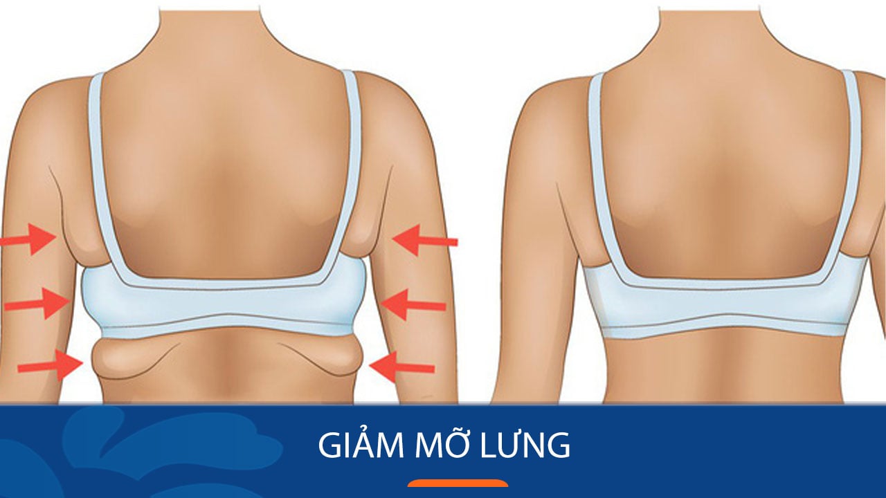 10 cách giảm mỡ lưng, vai an toàn, hiệu quả nhất với cả nam và nữ