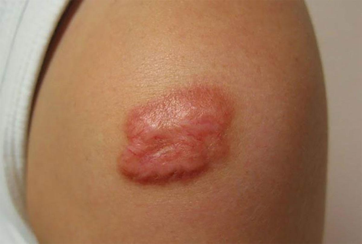 Các cách trị sẹo lồi hiệu quả an toàn nhất hiện nay