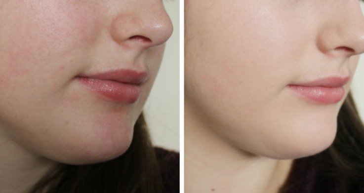 Bật mí phương pháp phục hồi da mỏng yếu hiệu quả