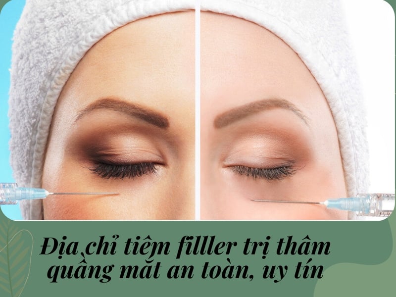 Tiêm filler trị thâm quầng mắt có tốt không?