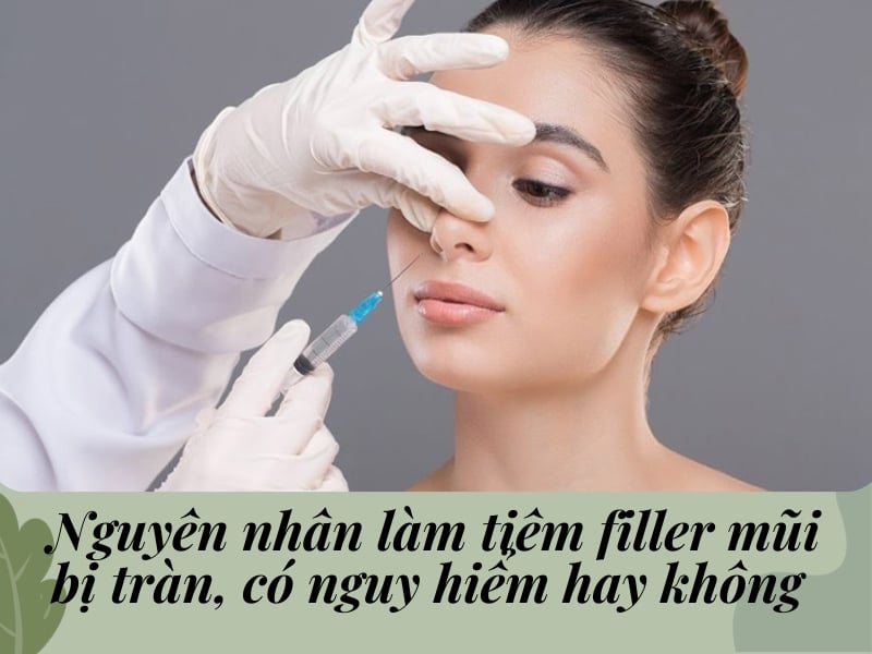 Tiêm filler mũi bị tràn: dấu hiệu, nguyên nhân, cách điều trị