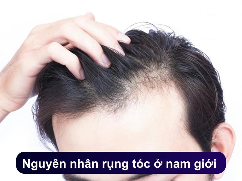 Nguyên nhân rụng tóc ở nam giới và cách khắc phục