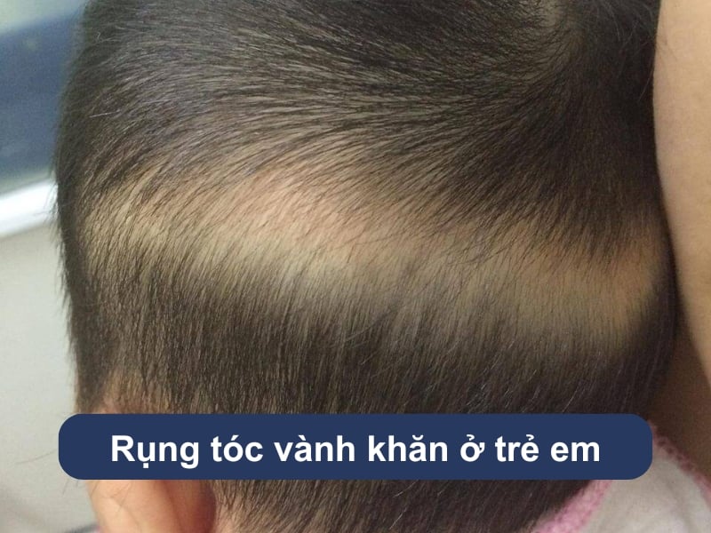 Rụng tóc vành khăn ở trẻ em