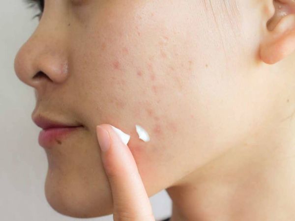 Các loại thuốc trị sẹo thâm hiệu quả hiện nay cho da