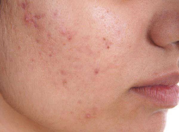 Cách trị sẹo mụn hiệu quả và nhanh chóng