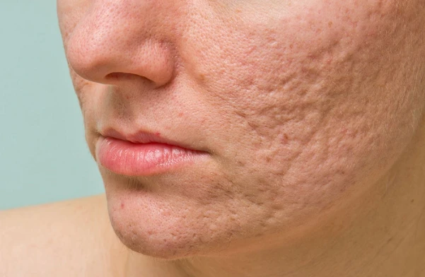 Sẹo rỗ: nguyên nhân, phân loại và cách điều trị