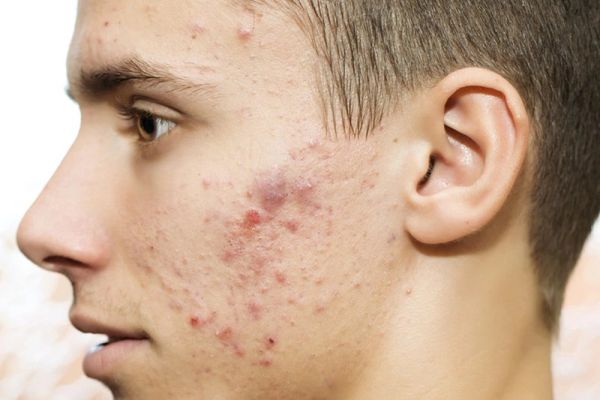 Nguyên nhân hình thành sẹo thâm và cách trị điều trị