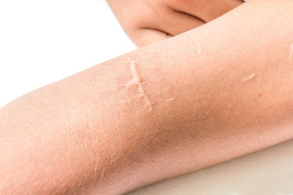 Sẹo trắng: biểu hiện, nguyên nhân và cách điều trị