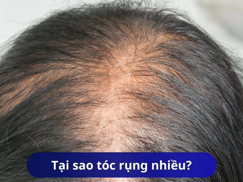 Tại sao tóc rụng nhiều? Nguyên nhân gây rụng tóc và cách điều trị