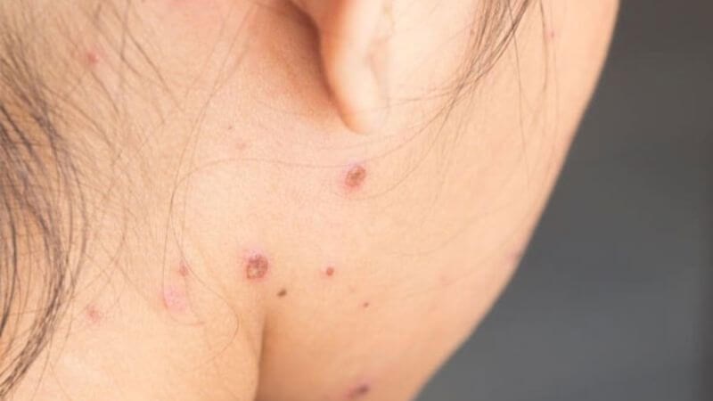 Thủy đậu là gì? Cách trị sẹo thủy đậu hiệu quả nhất
