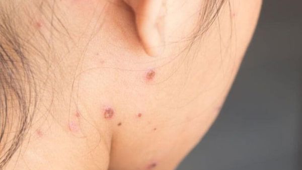 Thủy đậu là gì? Cách trị sẹo thủy đậu hiệu quả nhất