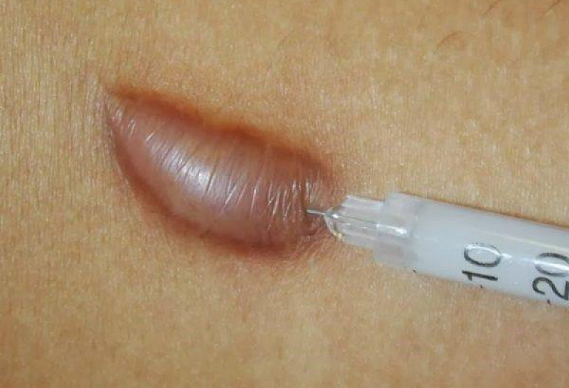 Tiêm sẹo lồi là gì và những điều bạn cần biết