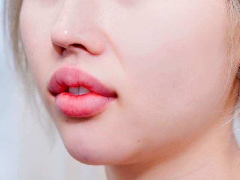 Dấu hiệu của tiêm filler bị vón cục và cách khắc phục