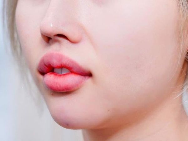 Dấu hiệu của tiêm filler bị vón cục và cách khắc phục