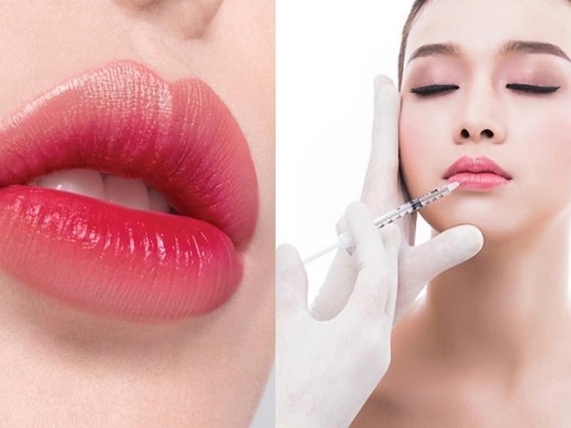 Tiêm môi baby: tạo hình môi cho vẻ đẹp tự nhiên