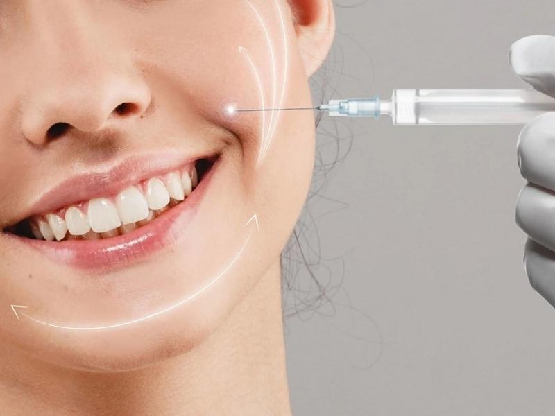 Tiêm filler rãnh cười là gì? Tiêm rãnh cười giá bao nhiêu?