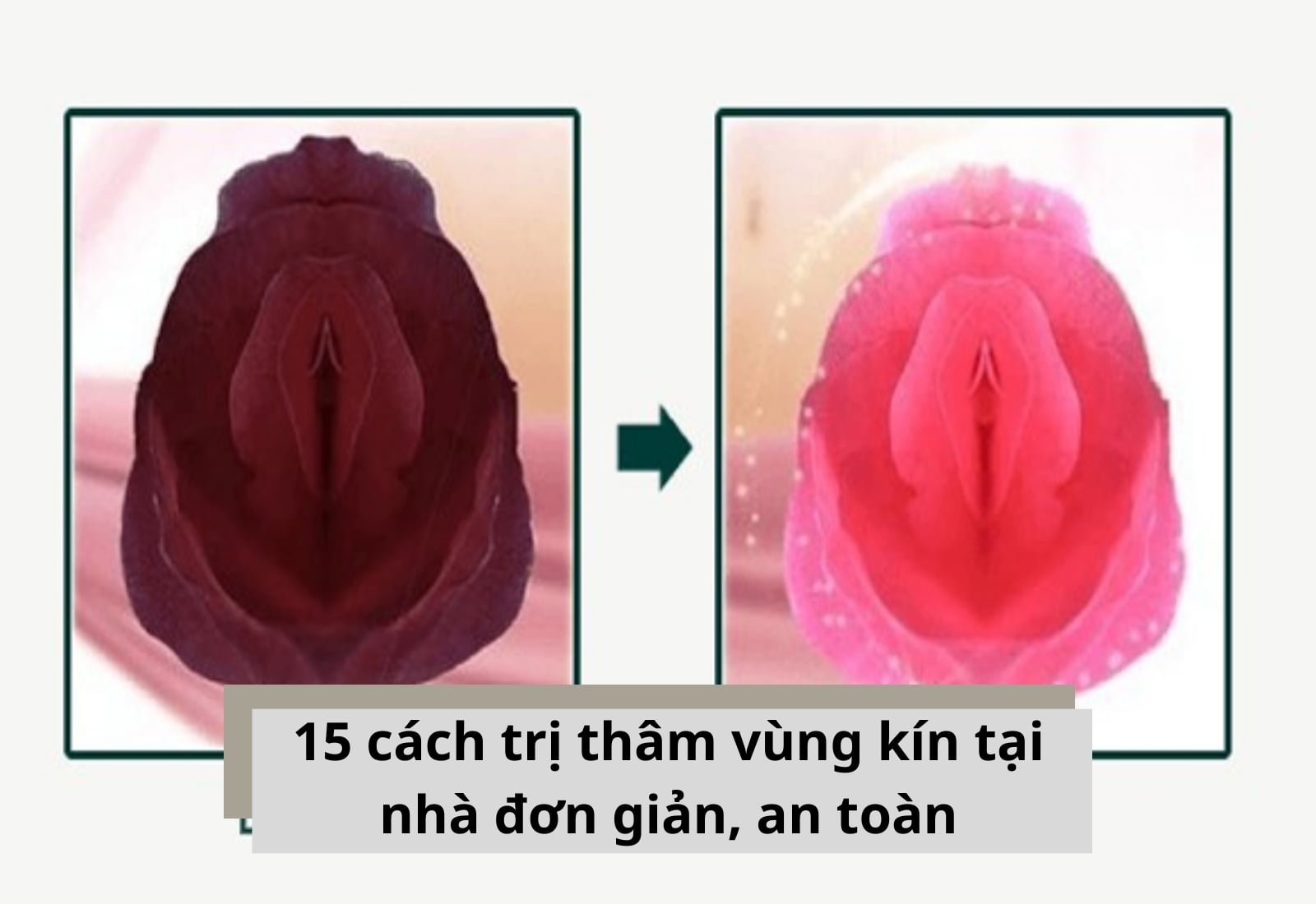 15 cách trị thâm vùng kín tại nhà đơn giản, an toàn bạn nên biết
