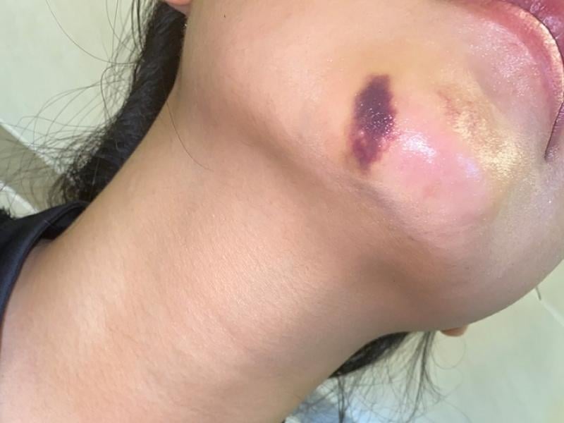 Vết tiêm filler bị bầm tím: nguyên nhân và cách khắc phục