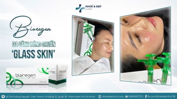 CẤY COLLAGEN - DA CĂNG MỌNG NHƯ SƯƠNG SỚM