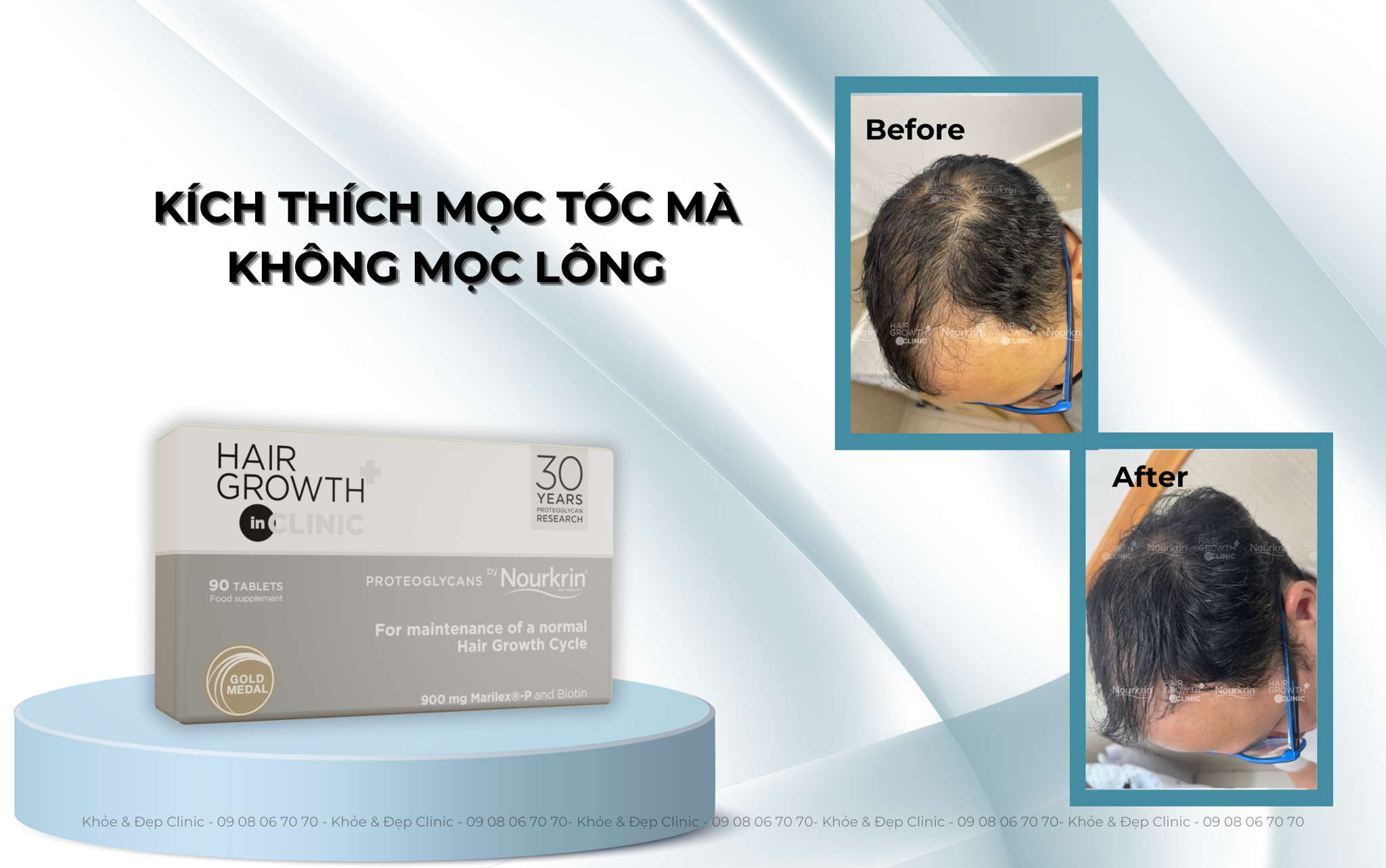 Kích thích mọc tóc mà không mọc lông