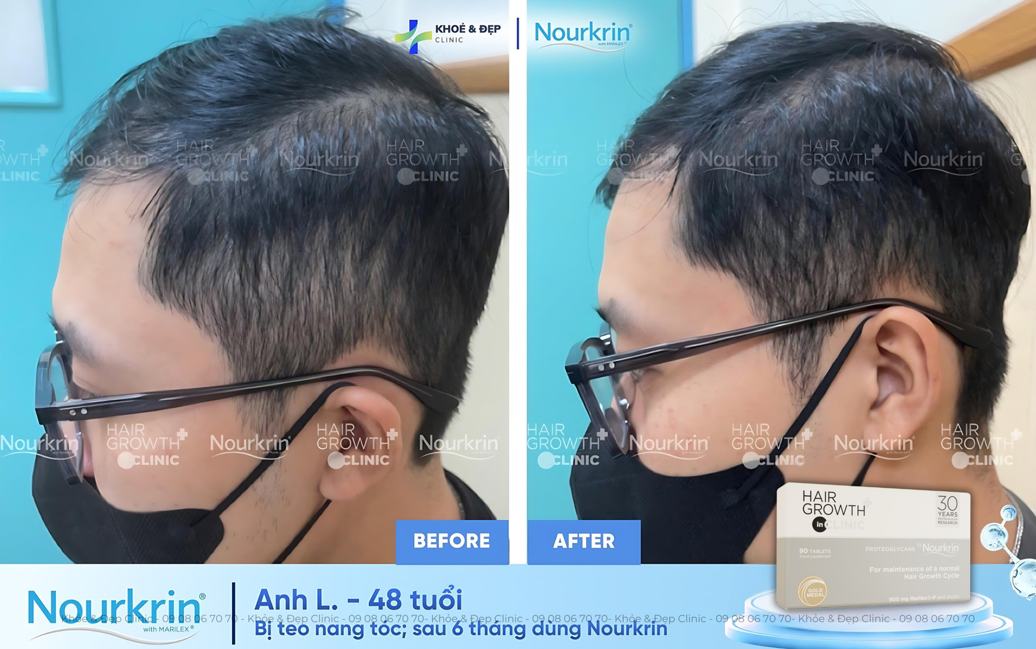 Hiệu quả với cả những ca rụng tóc khó điều trị