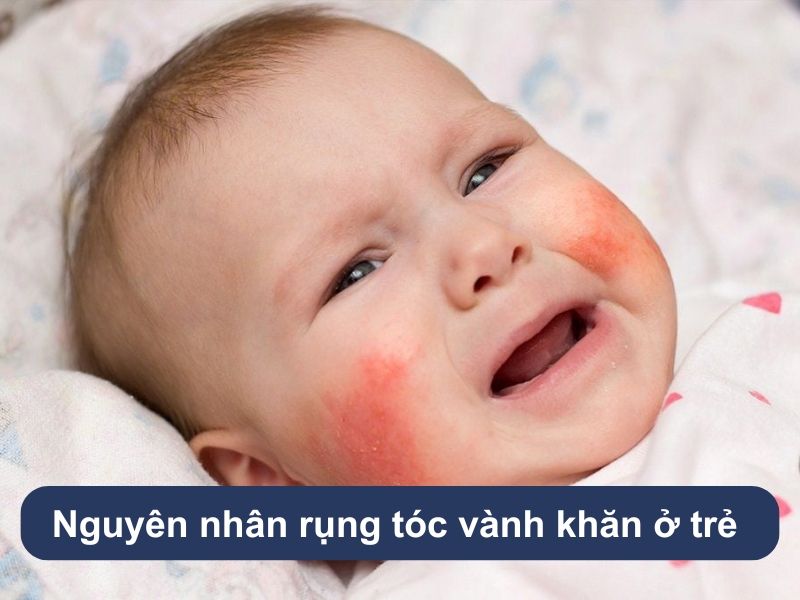 Nguyên nhân rụng tóc vành khăn ở trẻ sơ sinh phổ biến