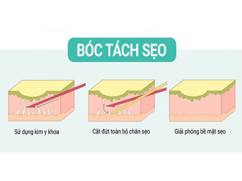 Bóc tách đáy sẹo