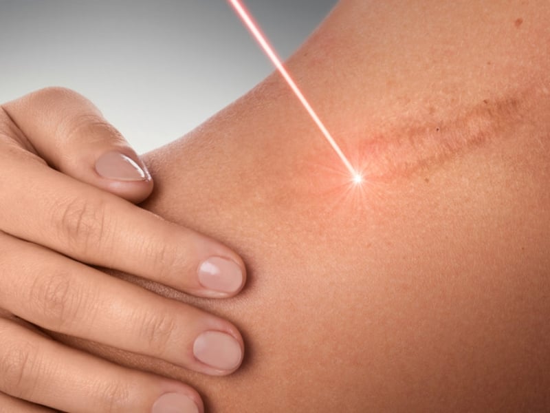 Các biện pháp trị sẹo lồi hiệu quả, an toàn