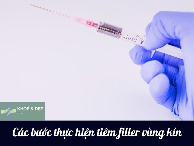 Quy trình thực hiện tiêm filler vùng kín