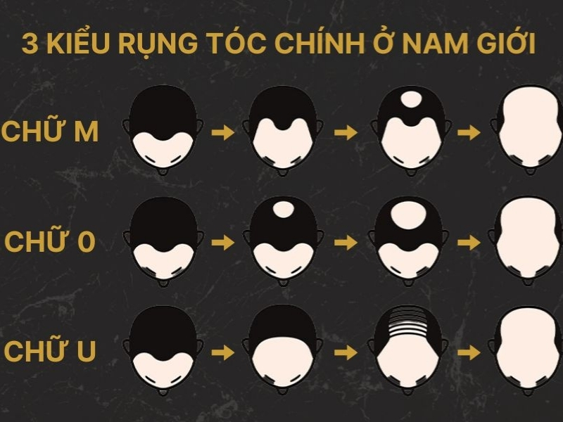 Các kiểu rụng tóc ở nam giới