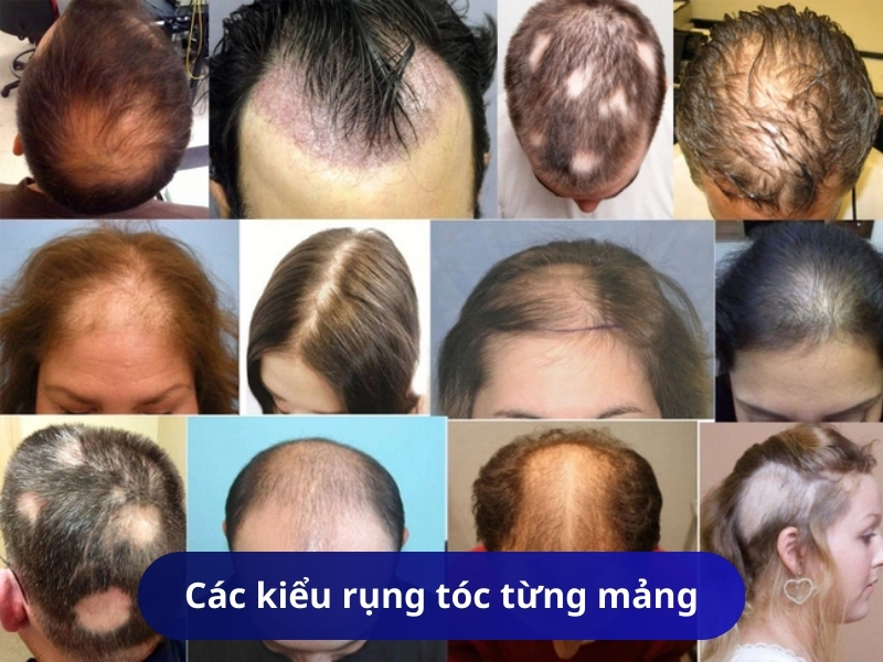 Các kiểu rụng tóc từng mảng