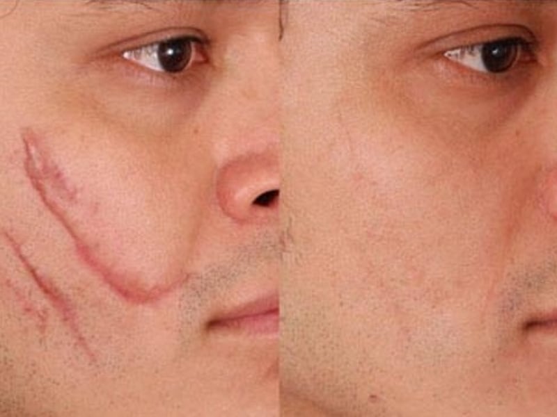 Các ưu và nhược điểm của kem trị sẹo của Nhật