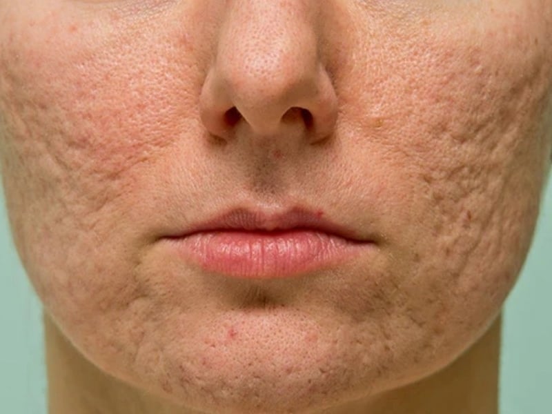 Các vị trí sẹo bị rỗ trên da phổ biến