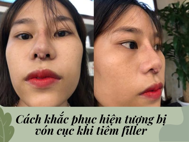 Cách khắc phục hiện tượng bị vón cục khi tiêm filler