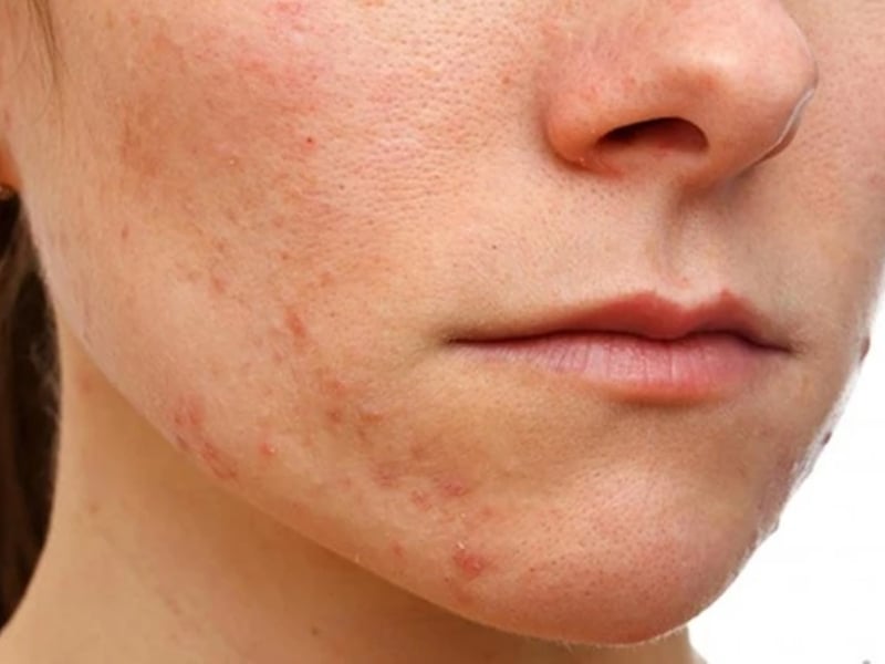 Cách nhận biết làn da bị nhiễm corticoid