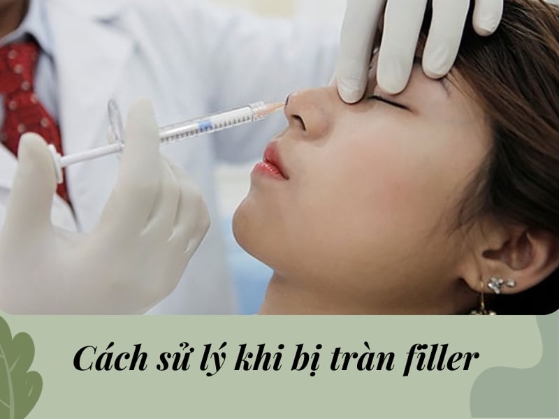 Cách xử lý khi bị tràn filler ở mũi