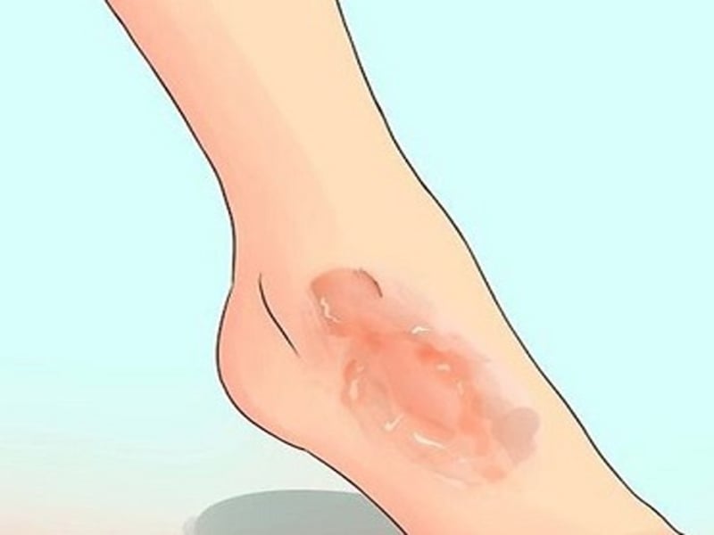 Cách trị sẹo mới