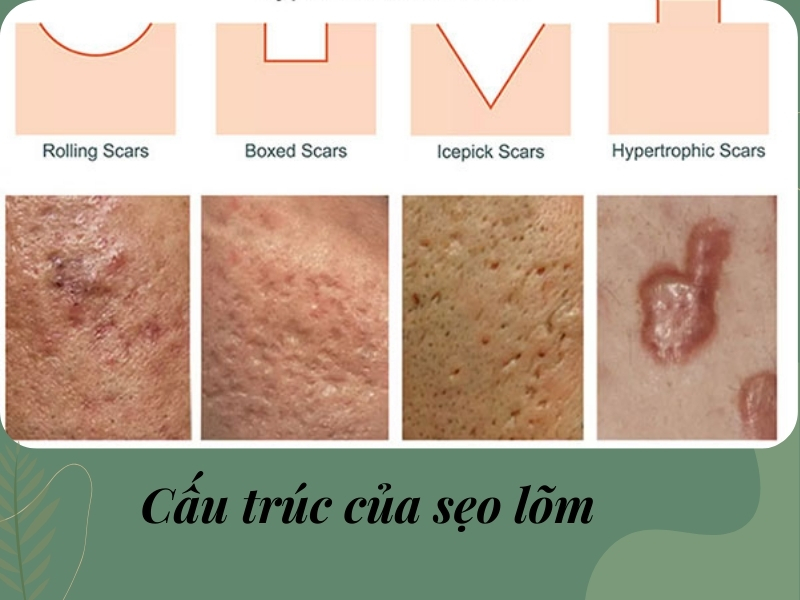 Cấu trúc của sẹo lõm
