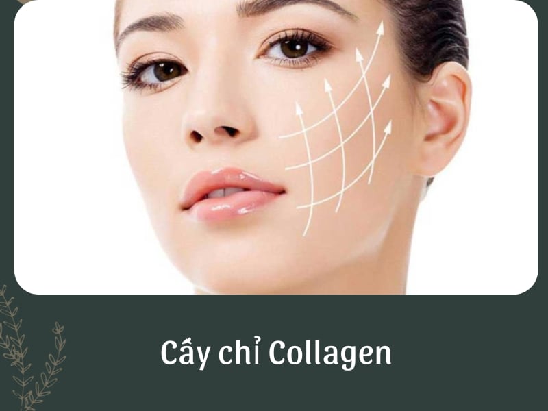 Cấy chỉ Collagen