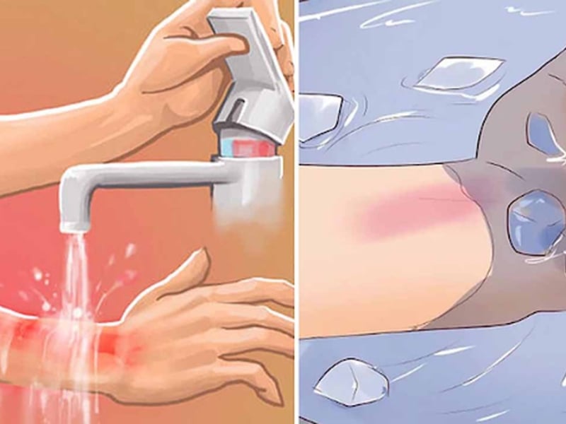 Chăm sóc sẹo bỏng đúng cách để không lưu lại sẹo