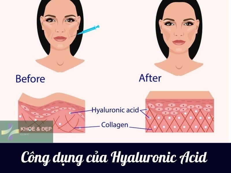 Lợi ích mà Hyaluronic Acid mang lại cho làn da