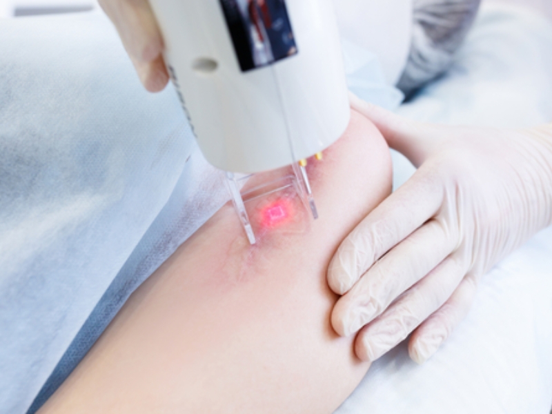 Công dụng của phương pháp xóa sẹo bằng laser