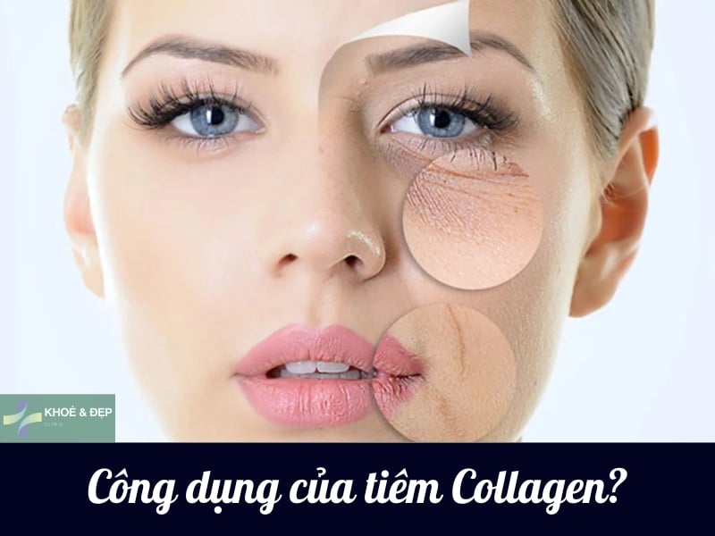 Tiêm collagen có tác dụng gì?