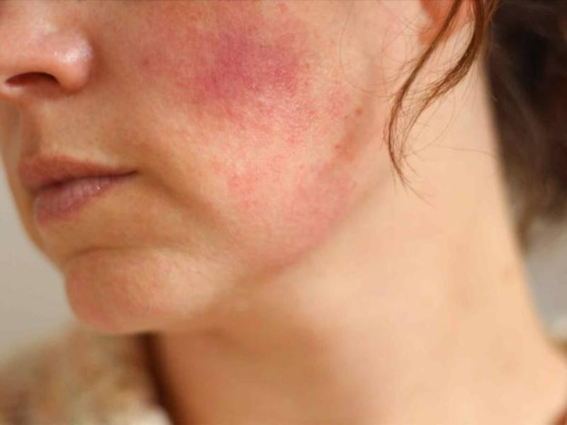 Da nhiễm corticoid là gì?