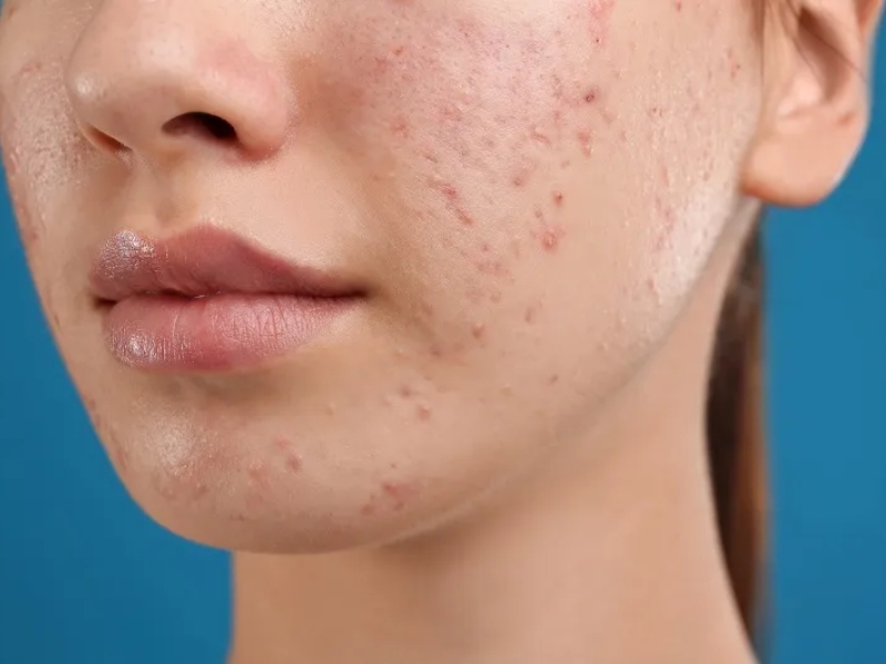 Đặc điểm của làn da sau mụn