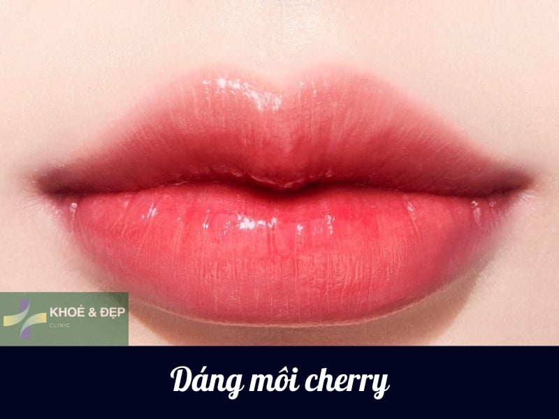 Tiêm môi filler dáng môi cherry