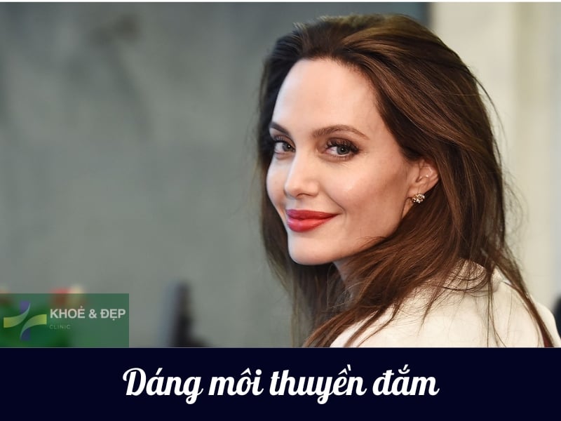 Tiêm filler dáng thuyền đắm