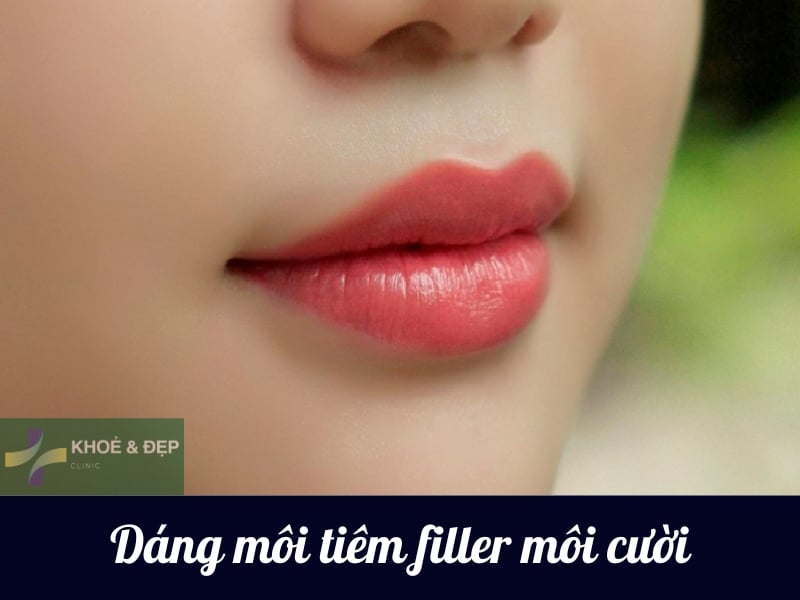 Dáng môi tiêm filler kiểu môi cười