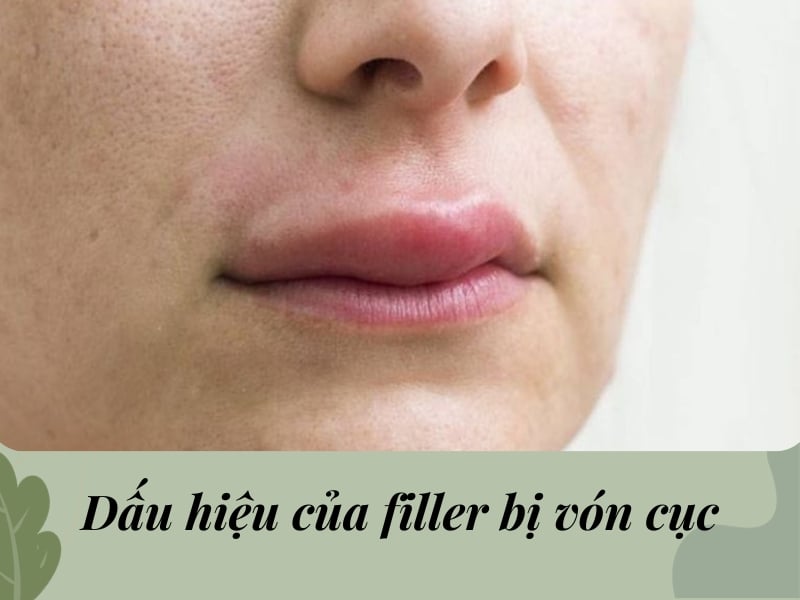 Dấu hiệu của filler bị vón cục
